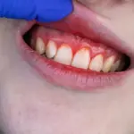 Beyond Antibiotics: International Clinical Trial Reveals Omega-3 and Aspirin Combination Matches Antibiotic Efficacy in Treating Severe Periodontitis
