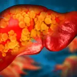 Healing the Liver Through the Gut: Michigan Medicine Researchers Reveal Breakthrough Therapy for Severe Fatty Liver Disease