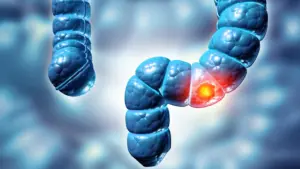 The Silent Surge: Why Advanced Colorectal Cancer Is Striking the Young—and Why Doctors Are Missing It