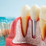 The Titanium Trap: How a Hidden Immune Mechanism Explains Why Dental Implant Infections Defy Modern Medicine