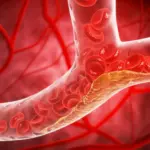 Unveiling the Silent Threat: Landmark Study Reveals Widespread Hidden Atherosclerosis in Apparently Healthy Young Adults